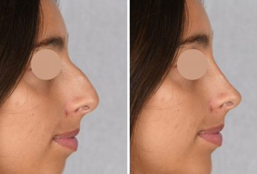 Foto de antes e depois de paciente não identificada após realizar perfiloplastia pelo médico Henry Delmar