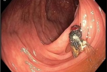 Fotografia de mosca viva dentro de intestino grosso, durante um exame de rotina