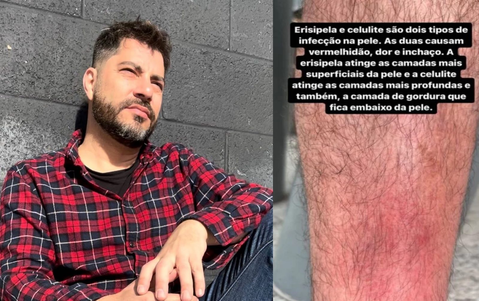 Jornalista Evaristo Costa e imagem de sua perna que ele divulgou nas redes sociais ao falar de erisipela e celulite