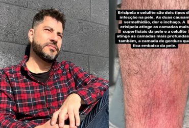 Jornalista Evaristo Costa e imagem de sua perna que ele divulgou nas redes sociais ao falar de erisipela e celulite