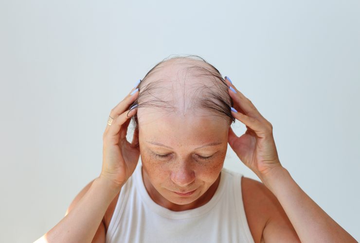 Perda de cabelo na forma de alopecia areata. Por nadzeyakolabava