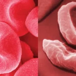 Na imagem da esquerda, glóbulos vermelhos normais e na imagem da direita, glóbulos da anemia falciforme