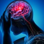 Cérebro humano tendo um ataque epilético