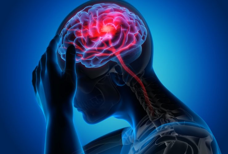 Cérebro humano tendo um ataque epilético