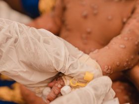 Criança de um mês recebe tratamento na unidade de isolamento de mpox do Hospital Kamanyola, apoiado pela UNICEF, na província de Kivu do Sul, República Democrática do Congo | Foto de Jospin Benekire para a UNICEF