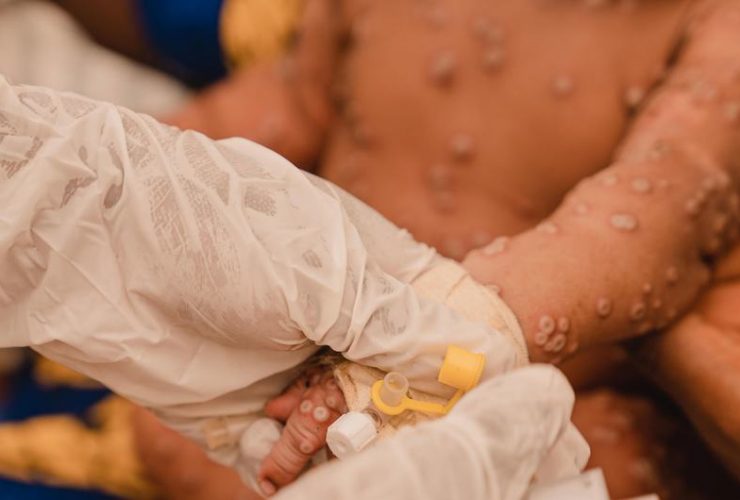 Criança de um mês recebe tratamento na unidade de isolamento de mpox do Hospital Kamanyola, apoiado pela UNICEF, na província de Kivu do Sul, República Democrática do Congo | Foto de Jospin Benekire para a UNICEF