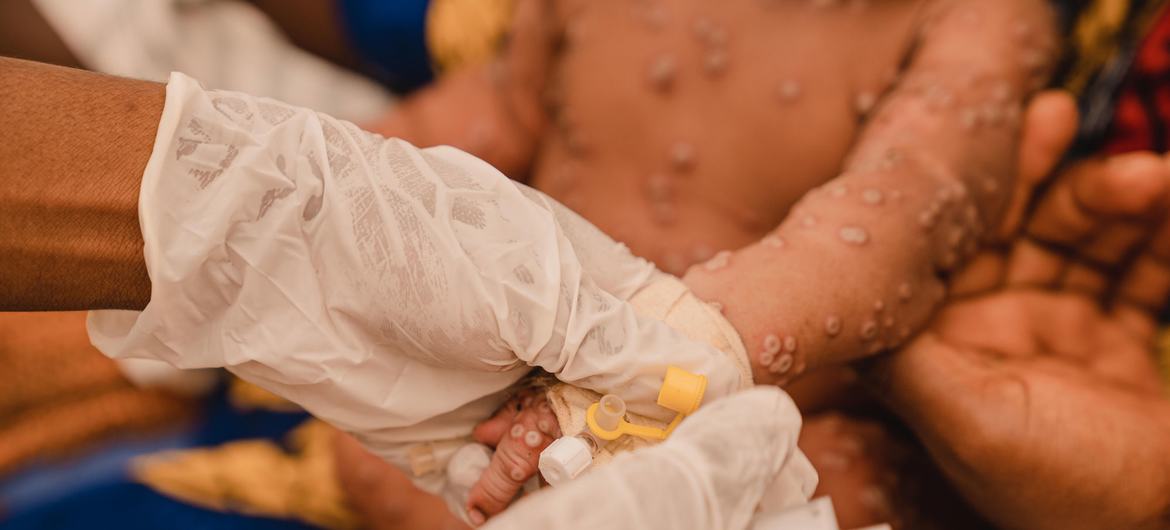 Criança de um mês recebe tratamento na unidade de isolamento de mpox do Hospital Kamanyola, apoiado pela UNICEF, na província de Kivu do Sul, República Democrática do Congo | Foto de Jospin Benekire para a UNICEF