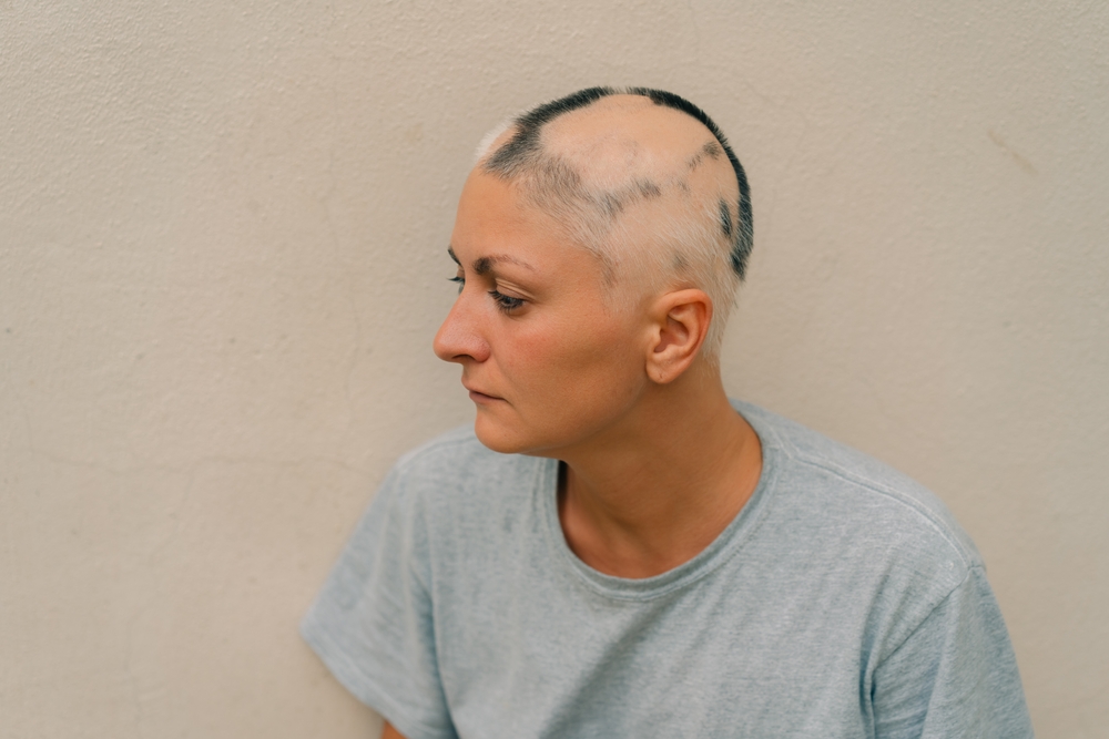 Mulher com alopecia