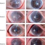 Imagem do antes e depois do olho de um dos pacientes que teve a visão restaurada na pesquisa