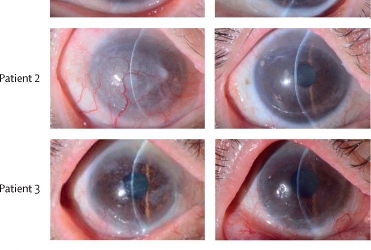 Imagem do antes e depois do olho de um dos pacientes que teve a visão restaurada na pesquisa Foto: artigo científico publicado no The Lancet