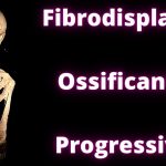 Doença Fibrodisplasia Ossificante Progressiva