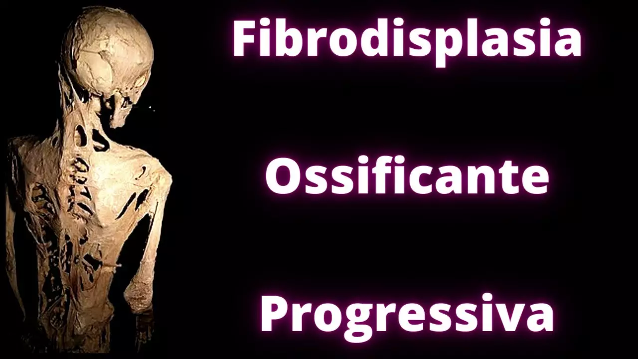 Doença Fibrodisplasia Ossificante Progressiva