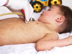 Criança com sarampo sendo examinada