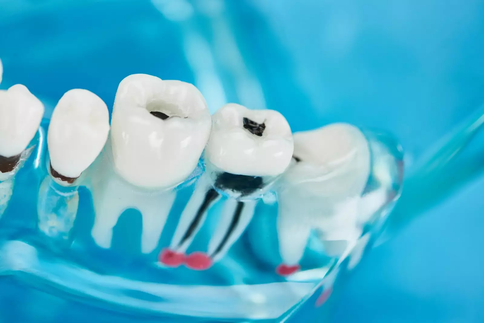 modelo de foco seletivo de dentes com cárie dentária em dentes brancos sobre azul Por LightFieldStudios