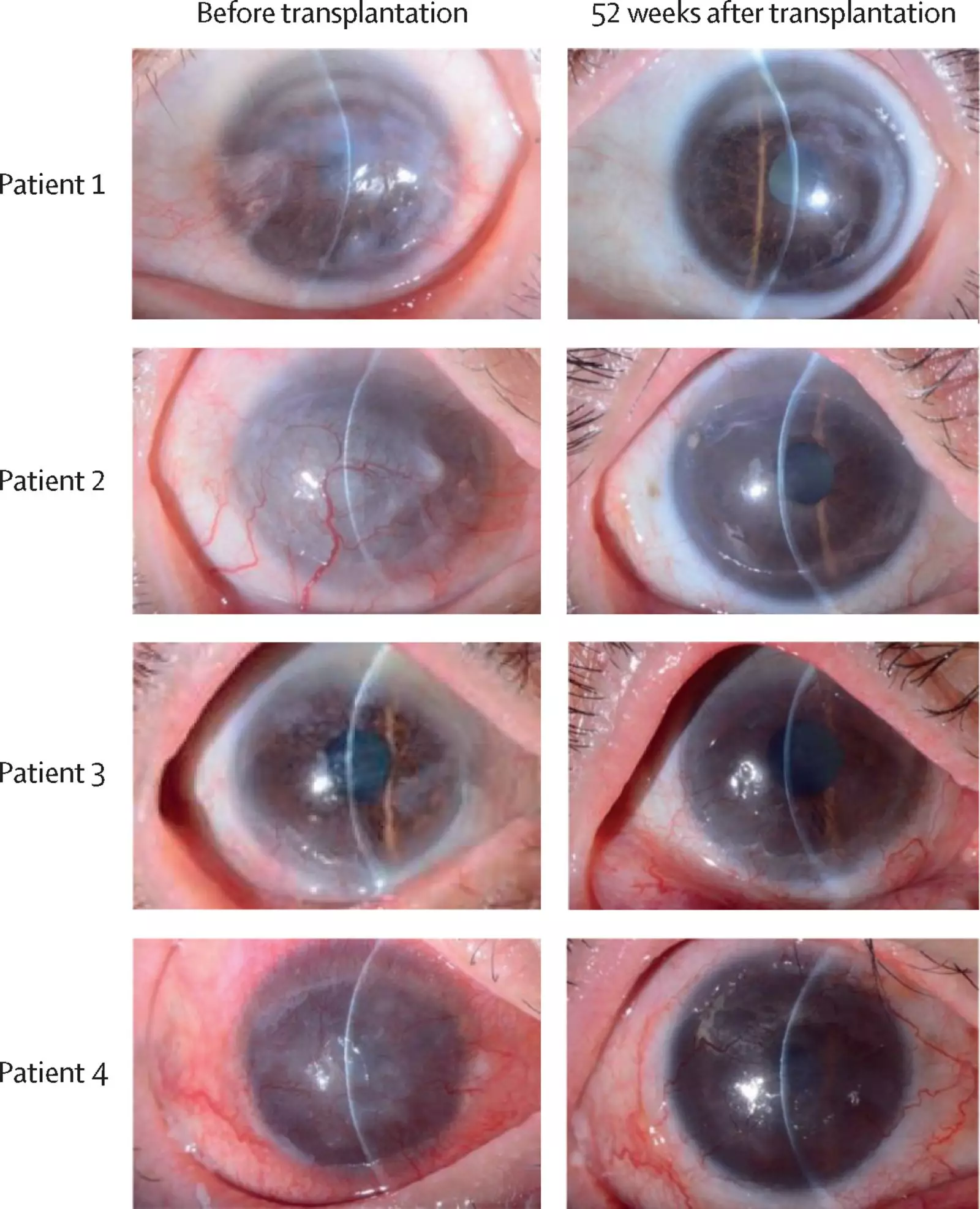 Imagem do antes e depois do olho de um dos pacientes que teve a visão restaurada na pesquisa Foto: artigo científico publicado no The Lancet